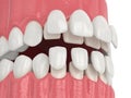 3d render of jaw with upper and lower veneers Royalty Free Stock Photo