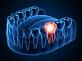 3d render of jaw x-ray with aching tooth