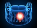 3d render of  jaw x-ray with aching tooth Royalty Free Stock Photo
