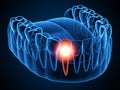 3d render of  jaw x-ray with aching tooth Royalty Free Stock Photo