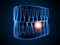 3d render of  jaw x-ray with aching tooth Royalty Free Stock Photo