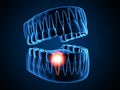 3d render of  jaw x-ray with aching tooth Royalty Free Stock Photo