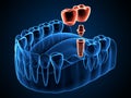 3d render of jaw x-ray with dental cantilever bridge