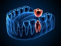 3d render of jaw x-ray with dental crown embed on tooth