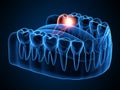 3d render of jaw x-ray with wisdom mesial impaction Royalty Free Stock Photo