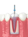 3d render of lower jaw with endodontic rotary file over white background