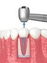 3d render of lower jaw with handpiece and endodontic rotary file over white background