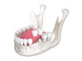 3d render of mandible with dental cantilever bridge over white