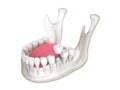 3d render of mandible with dental crown embed on reshaped tooth over white