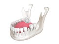 3d render of mandible with dental crown embed on reshaped tooth over white