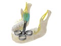 3d render of mandibular arch with inferior alveolar nerve block