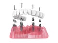 3d render of mandibular prosthesis all-on-6 system supported by implants