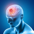 3D medical image showing male figure with brain tumour Royalty Free Stock Photo