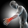 3D render of a medical male figure showing his painful wrist with joints highlighted