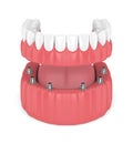 3d render of removable full implant denture