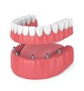 3d render of removable full implant denture