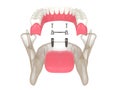 3d render of removable overdenture installation on bar clip attachment supported by implants Royalty Free Stock Photo