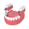 3d render of removable partial denture Royalty Free Stock Photo