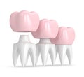 3d render of replacement crown cemented onto reshaped tooth Royalty Free Stock Photo