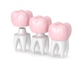 3d render of replacement crown cemented onto reshaped tooth Royalty Free Stock Photo