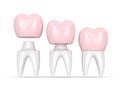 3d render of replacement crown cemented onto reshaped tooth Royalty Free Stock Photo