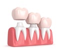 3d render of replacement crowns cemented onto reshaped teeth Royalty Free Stock Photo