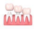 3d render of replacement crowns cemented onto reshaped teeth Royalty Free Stock Photo