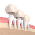 3d render of replacement crowns cemented onto reshaped teeth Royalty Free Stock Photo