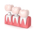 3d render of replacement crowns cemented onto reshaped teeth Royalty Free Stock Photo