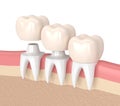 3d render of replacement crowns cemented onto reshaped teeth Royalty Free Stock Photo