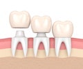 3d render of replacement crowns cemented onto reshaped teeth Royalty Free Stock Photo