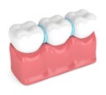 3d render of rubber separators between teeth