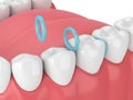 3d render of rubber separators between teeth