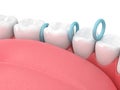 3d render of rubber separators between teeth