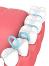 3d render of rubber separators between teeth