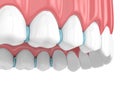 3d render of rubber separators between teeth