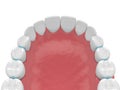 3d render of rubber separators between teeth