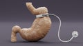 3D Render of Stomach with Gastric Band