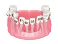 3d render of teeth alignment by orthodontic braces