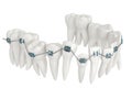 3d render of teeth alignment by orthodontic braces