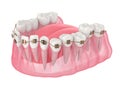 3d render of teeth alignment by orthodontic braces
