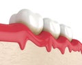 3d render of teeth in bleeding gums Royalty Free Stock Photo
