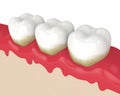 3d render of teeth in bleeding gums