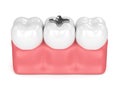 3d render of teeth with dental amalgam filling Royalty Free Stock Photo