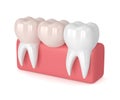 3d render of teeth with dental cantilever bridge