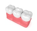 3d render of teeth with dental composite filling