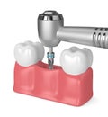 3d render of teeth with dental drill