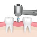 3d render of teeth with dental drill