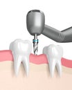 3d render of teeth with dental drill