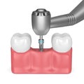 3d render of teeth with dental drill